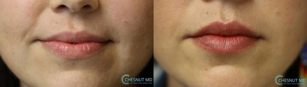 Micro-Structural Lip Augmentation Before & After Gallery - Patient 9511844 - Image 1
