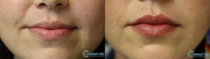 Before and After Micro-Sutural Lip Augmentation