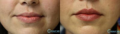 Micro-Structural Lip Augmentation Before & After Gallery - Patient 9511844 - Image 1