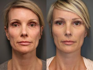 Before and after sculptra