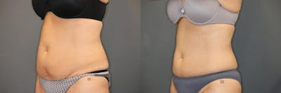 Coolsculpting Before & After Gallery - Patient 9511866 - Image 1