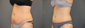 Before and after recieving CoolSculpting