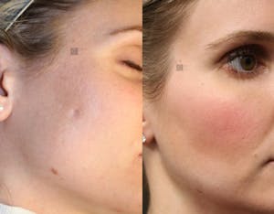 Before and after photodynamic acne scar remodeling