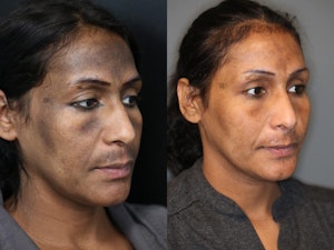 Before and after platelet rich plasma therapy in Spokane