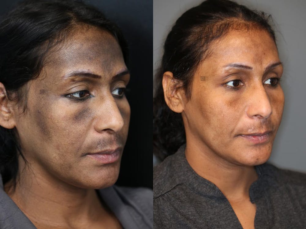 Platelet Rich Plasma Before & After Gallery - Patient 9945416 - Image 1