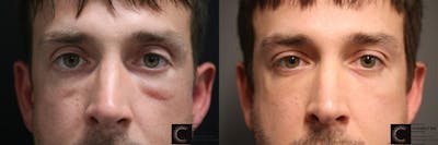 Hyaluronidase Before & After Gallery - Patient 9511900 - Image 1