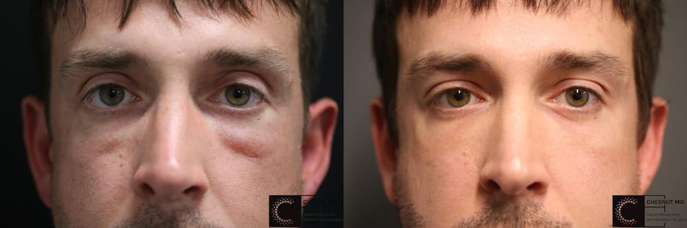 EnigmaLift - Eye Bag Removal Before & After Gallery - Patient 9511884 - Image 1