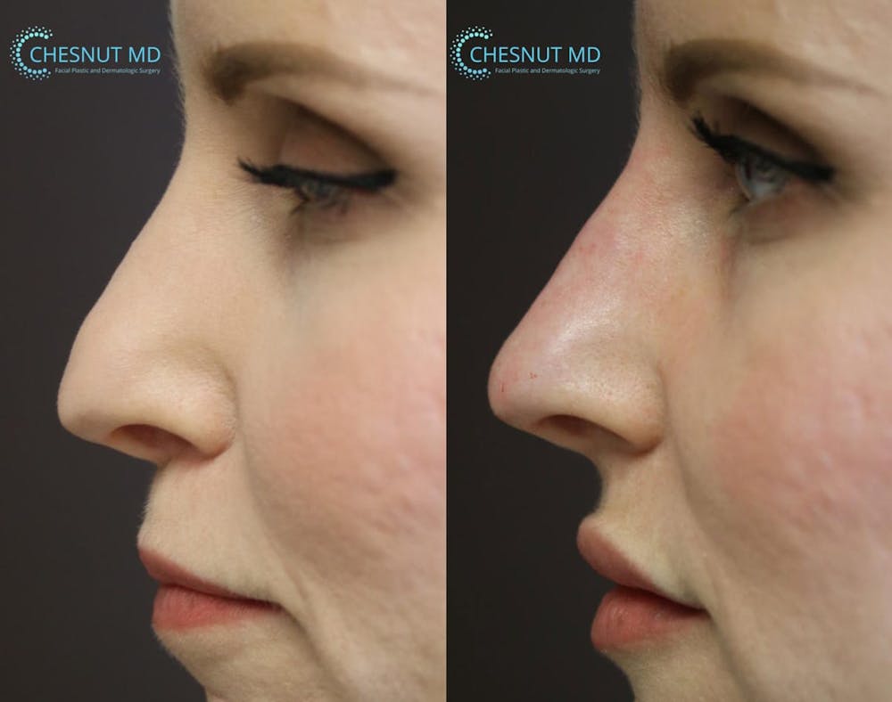 Non-Surgical Rhinoplasty Before & After Gallery - Patient 9511898 - Image 1
