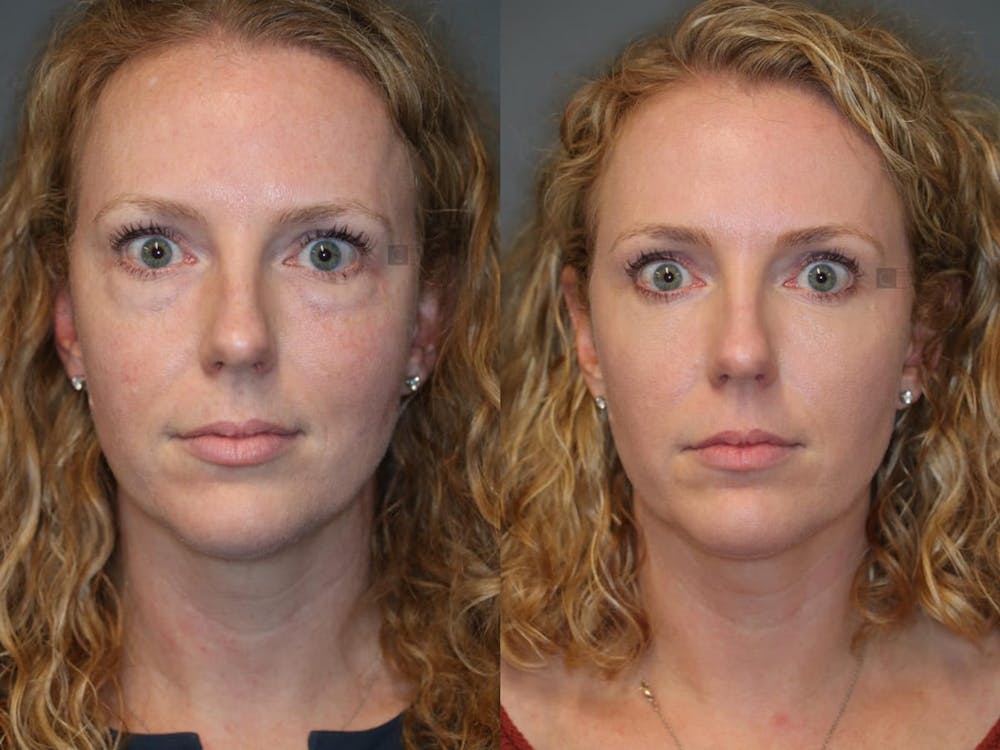 Temple Rejuvenation Before & After Gallery - Patient 9511907 - Image 1