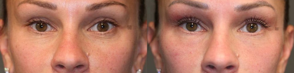 Platelet Rich Plasma Before & After Gallery - Patient 8560442 - Image 1