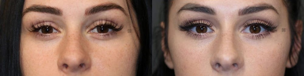 BOTOX, Dysport, Xeomin Before & After Gallery - Patient 8560553 - Image 1