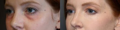 Tear Trough Correction Before & After Gallery - Patient 24089088 - Image 1