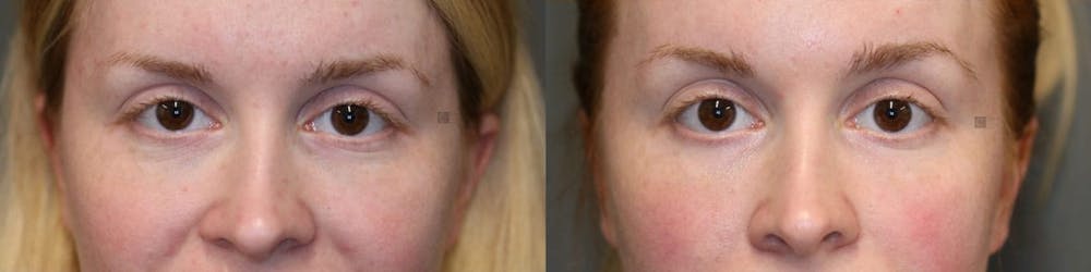 Platelet Rich Plasma Before & After Gallery - Patient 8560565 - Image 1