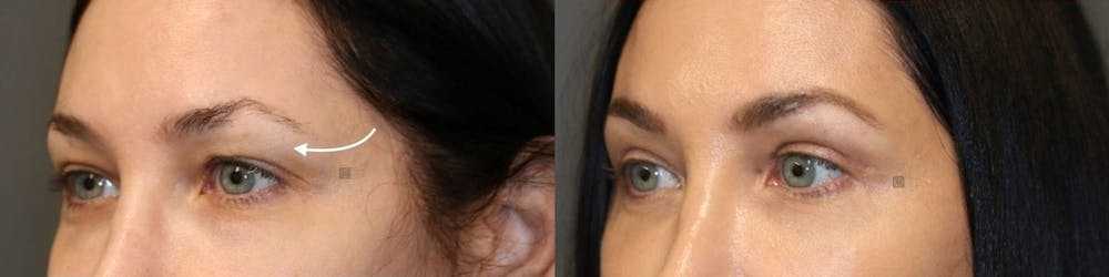  EnigmaLift - Upper Eyelid Surgery Before & After Gallery - Patient 8560569 - Image 1