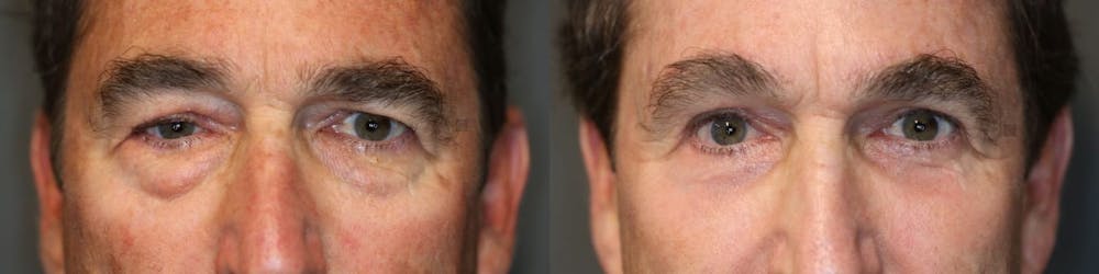 EnigmaLift - Brow Lift Before & After Gallery - Patient 8560362 - Image 1