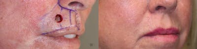 MOHS & Reconstruction Surgery Before & After Gallery - Patient 8560370 - Image 1