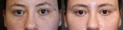 Platelet Rich Plasma Before & After Gallery - Patient 8560382 - Image 1