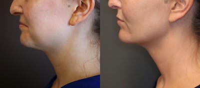 Structural Jawline Contouring Before & After Gallery - Patient 9494218 - Image 1