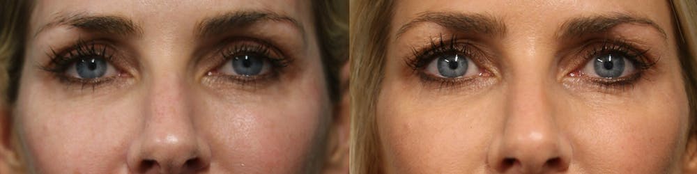 Dermal Fillers Before & After Gallery - Patient 25458565 - Image 1
