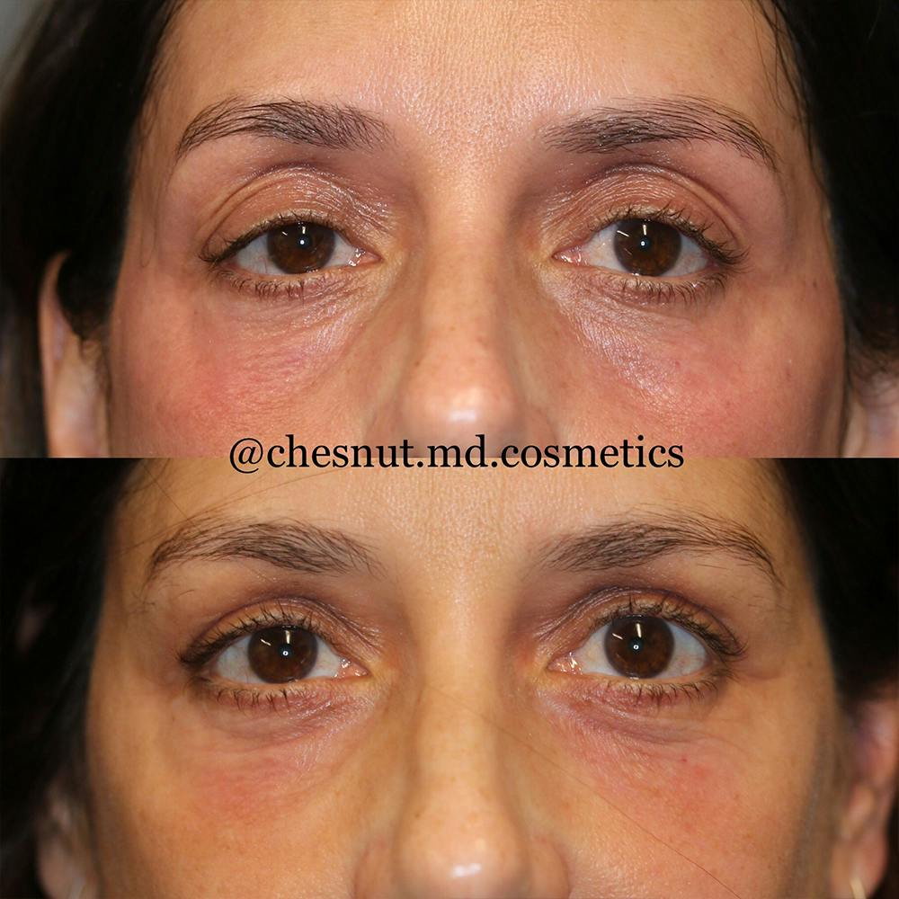 Dermal Fillers Before & After Gallery - Patient 25458607 - Image 1