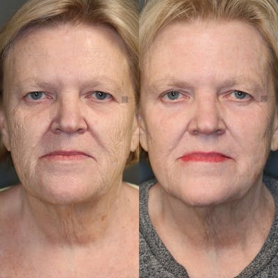Regenerative Medicine Before & After Gallery - Patient 25458813 - Image 1