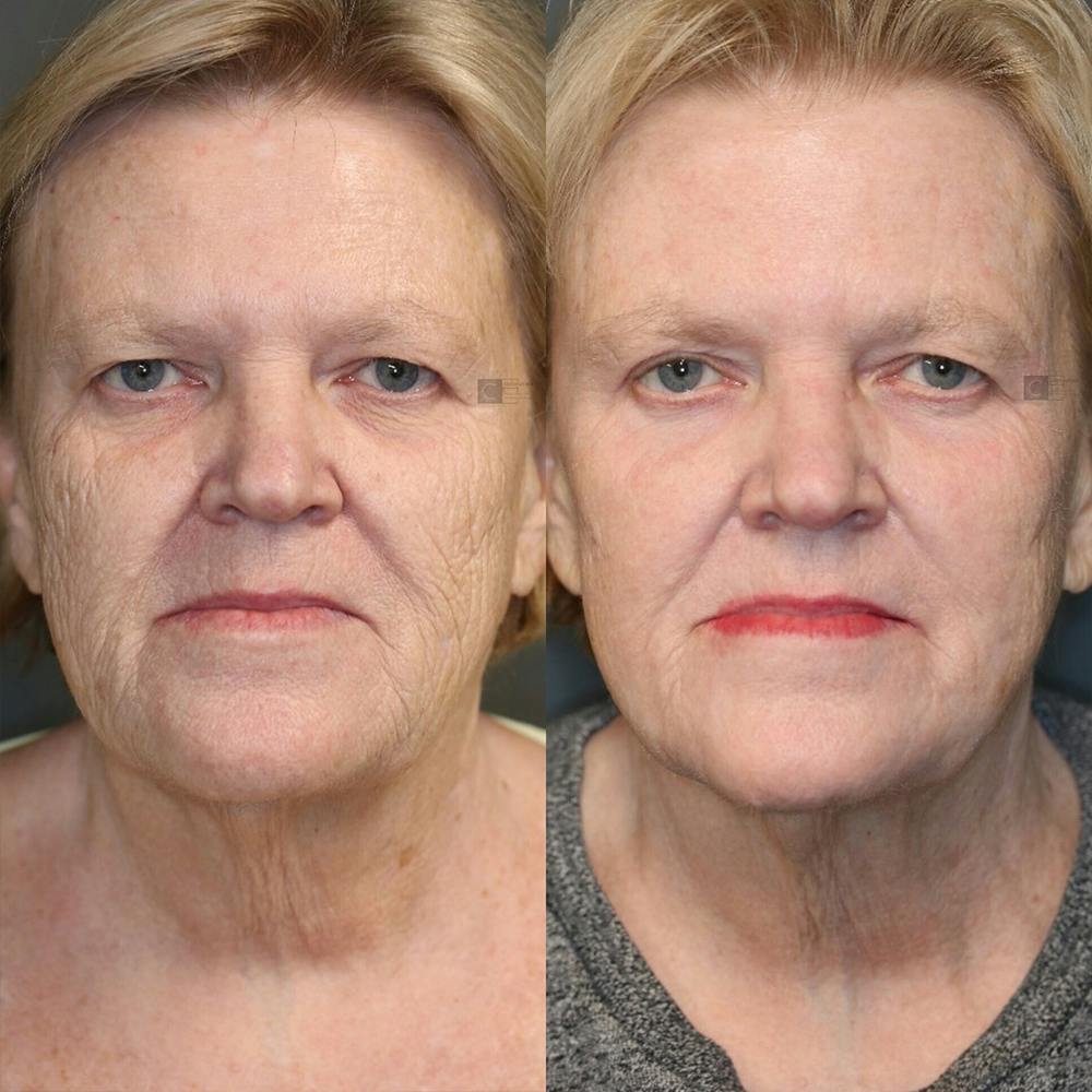ÔPTIMized Laser Cocktail Before & After Gallery - Patient 25458824 - Image 1