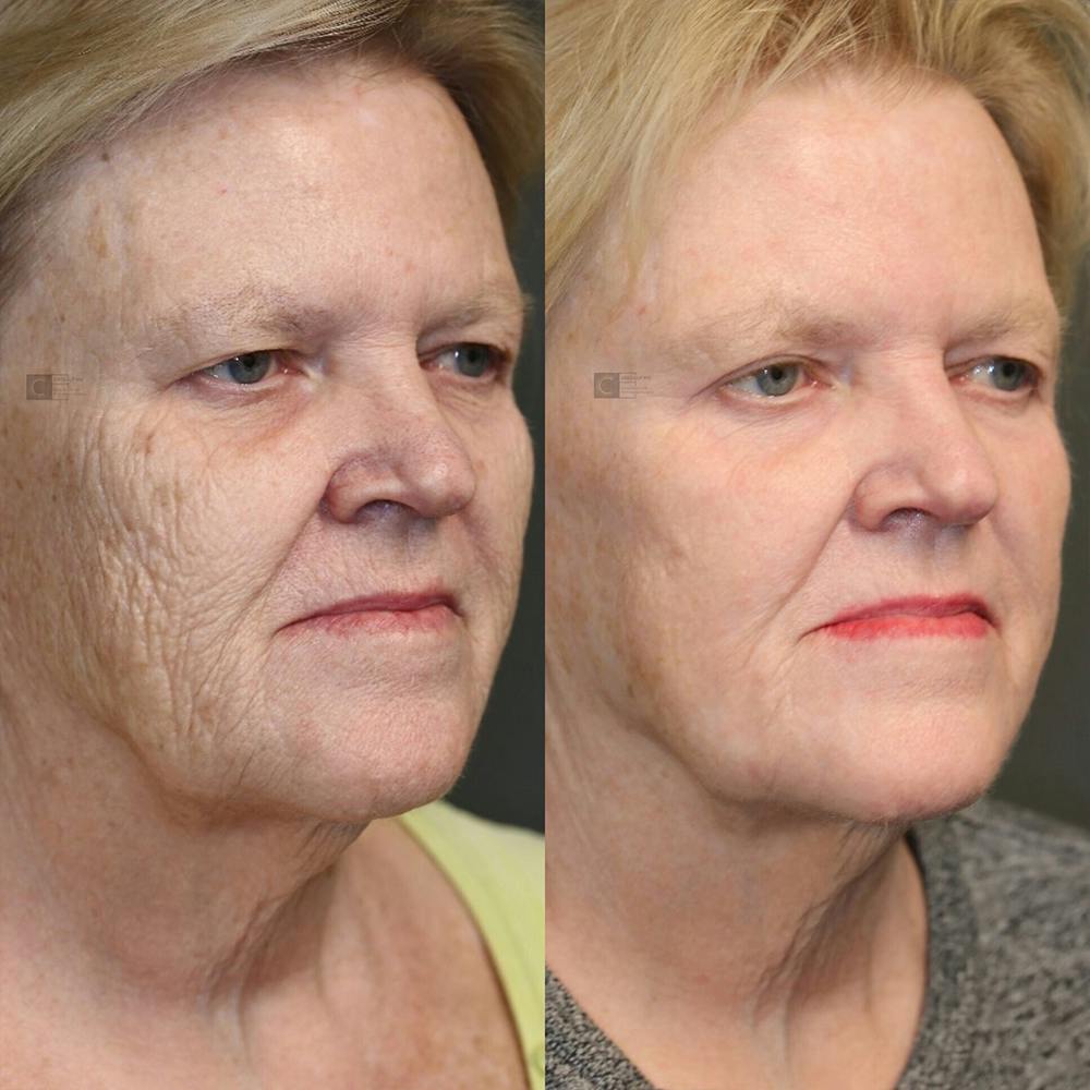 ÔPTIMized Laser Cocktail Before & After Gallery - Patient 25458824 - Image 2