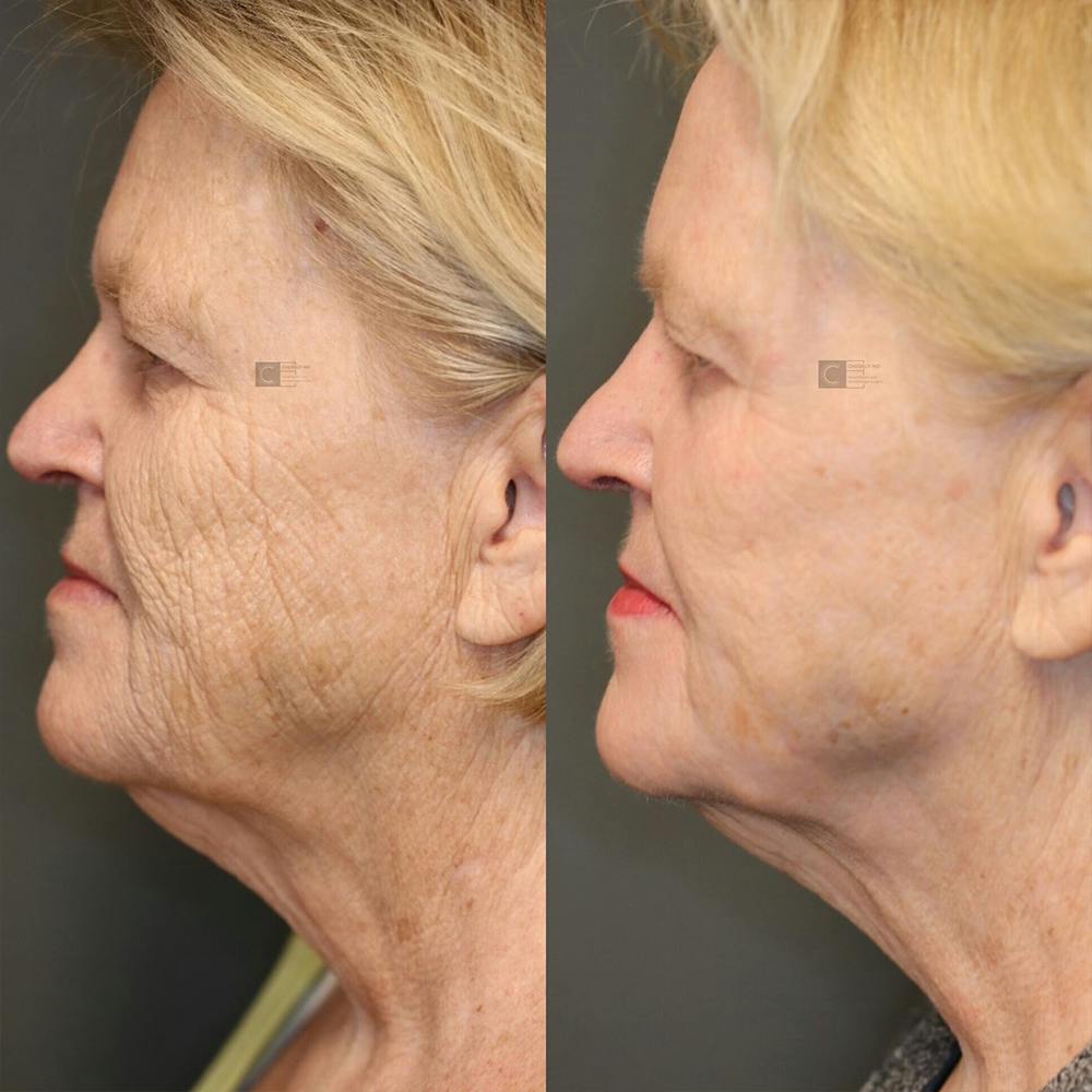 ÔPTIMized Laser Cocktail Before & After Gallery - Patient 25458824 - Image 3