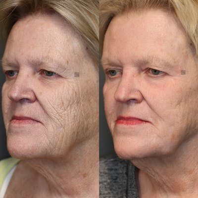 ÔPTIMized Laser Cocktail Before & After Gallery - Patient 25458824 - Image 4