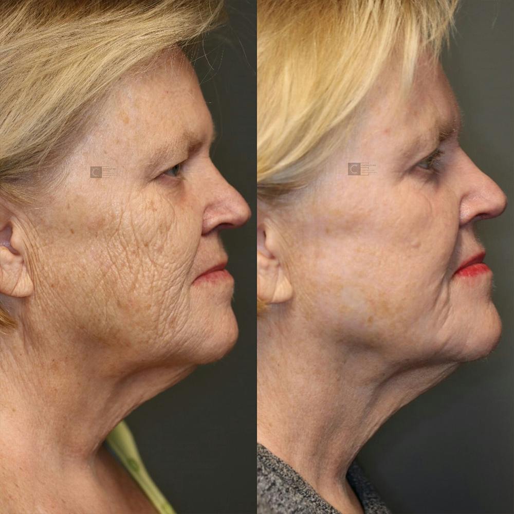 ÔPTIMized Laser Cocktail Before & After Gallery - Patient 25458824 - Image 5