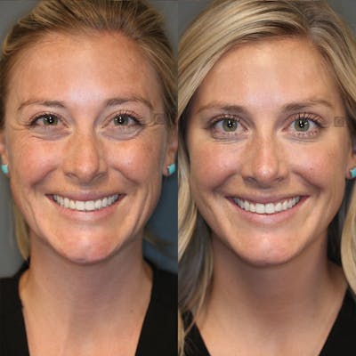 BOTOX, Dysport, Xeomin Before & After Gallery - Patient 25458982 - Image 1