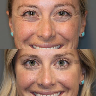 BOTOX, Dysport, Xeomin Before & After Gallery - Patient 25458982 - Image 2