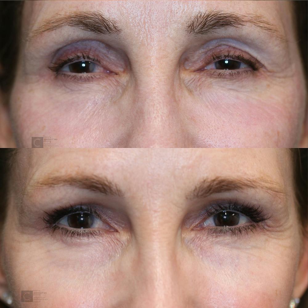 Dermal Fillers Before & After Gallery - Patient 25459022 - Image 1