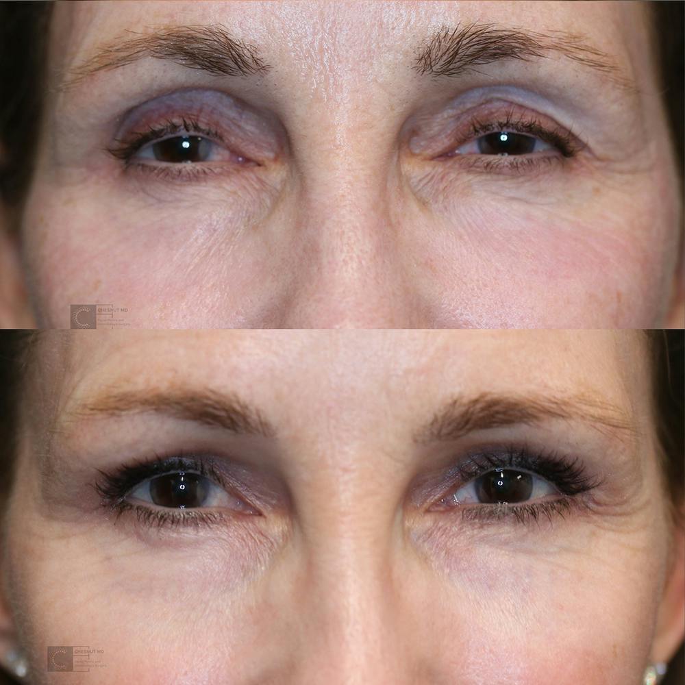  EnigmaLift - Upper Eyelid Surgery Before & After Gallery - Patient 25459031 - Image 1