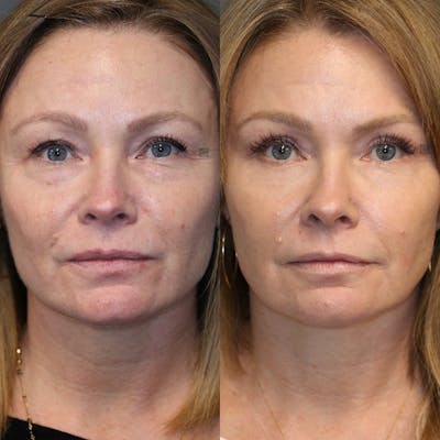 ÔPTIMized Laser Cocktail Before & After Gallery - Patient 25459043 - Image 1