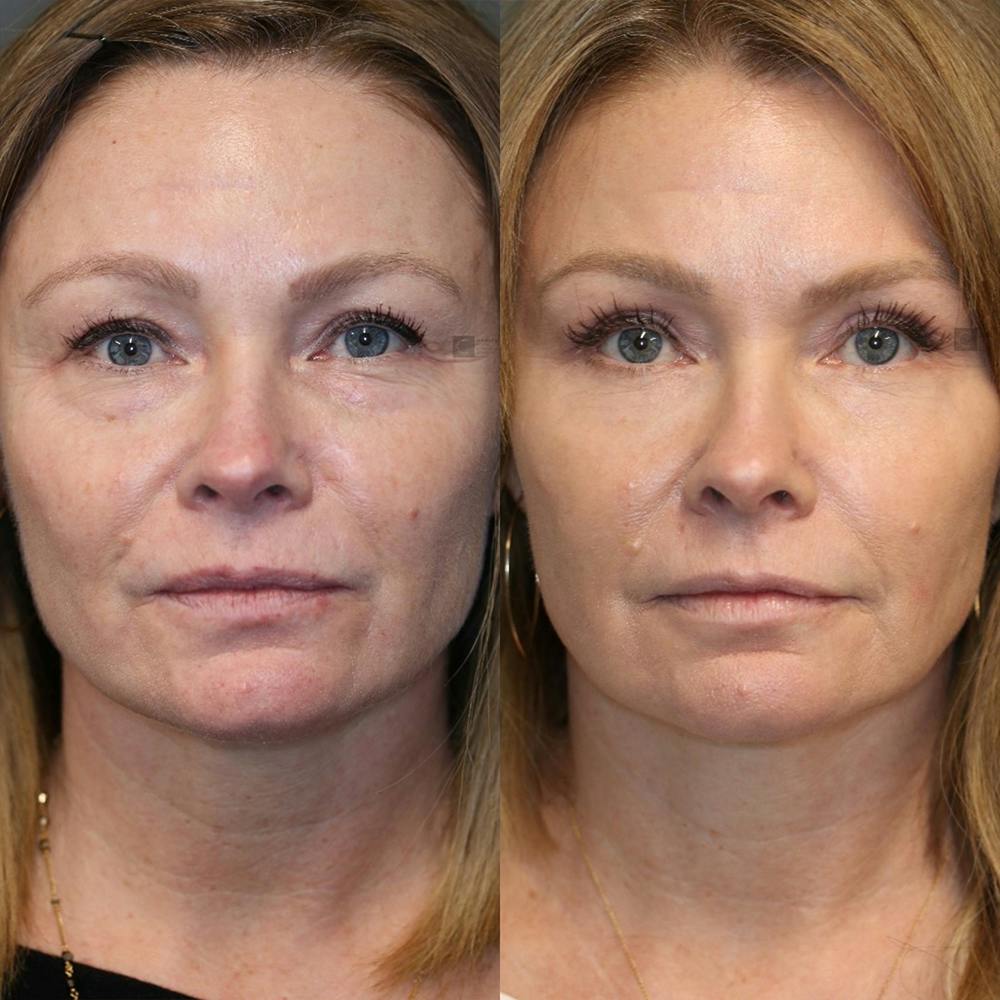 ÔPTIMized Laser Cocktail Before & After Gallery - Patient 25459043 - Image 1