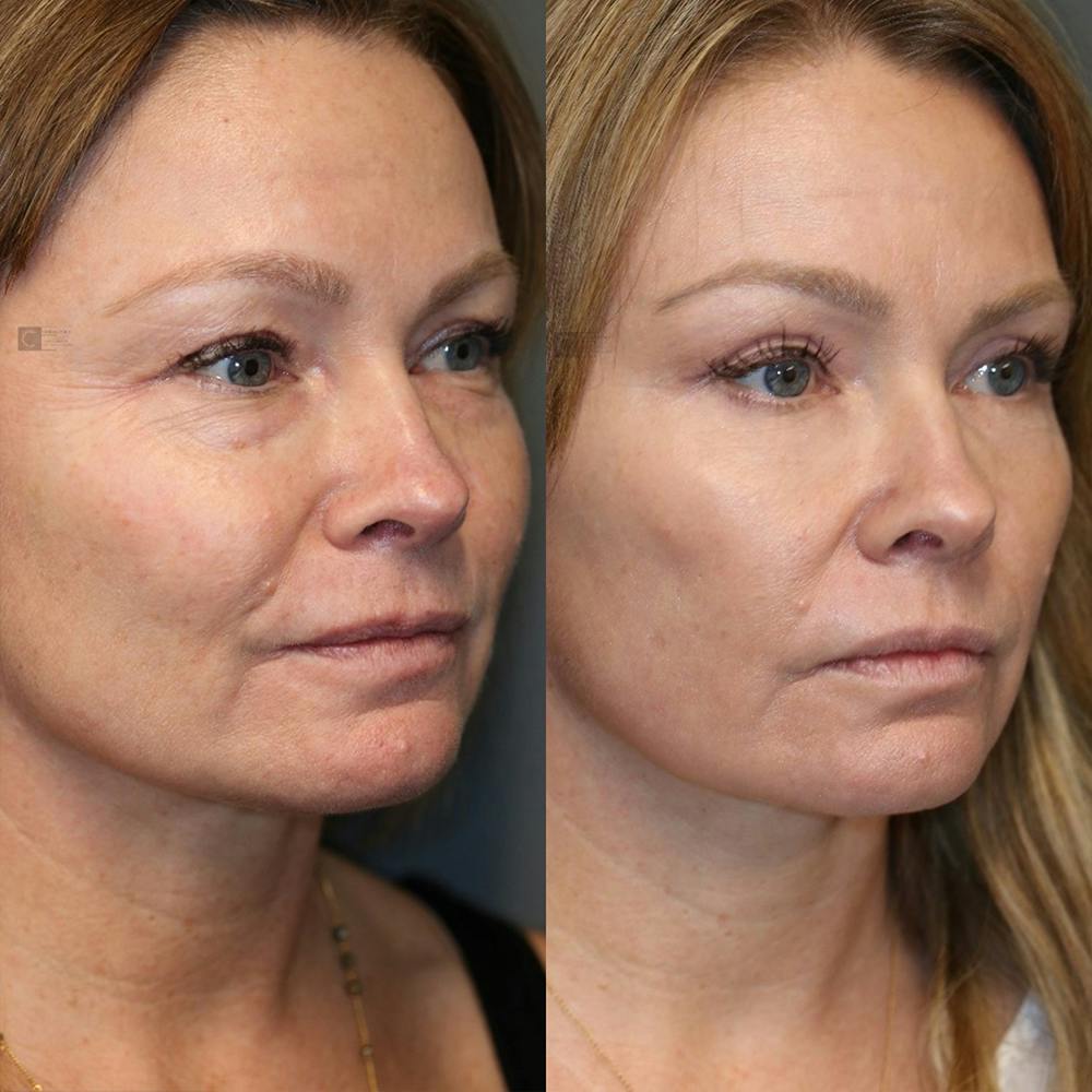 ÔPTIMized Laser Cocktail Before & After Gallery - Patient 25459043 - Image 2