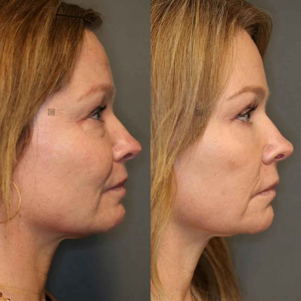 ÔPTIMized Laser Cocktail Before & After Gallery - Patient 25459043 - Image 3