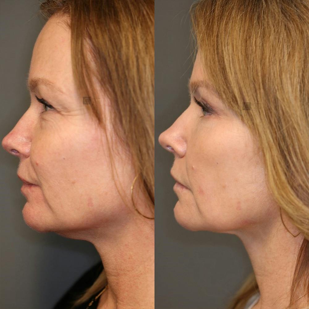 ÔPTIMized Laser Cocktail Before & After Gallery - Patient 25459043 - Image 4