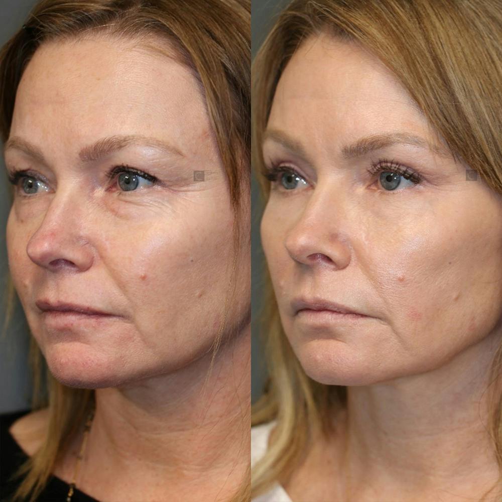 ÔPTIMized Laser Cocktail Before & After Gallery - Patient 25459043 - Image 5