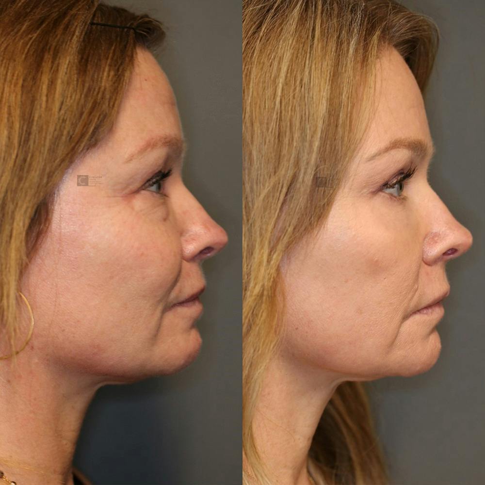 EnigmaLift - Eye Bag Removal Before & After Gallery - Patient 25459146 - Image 3