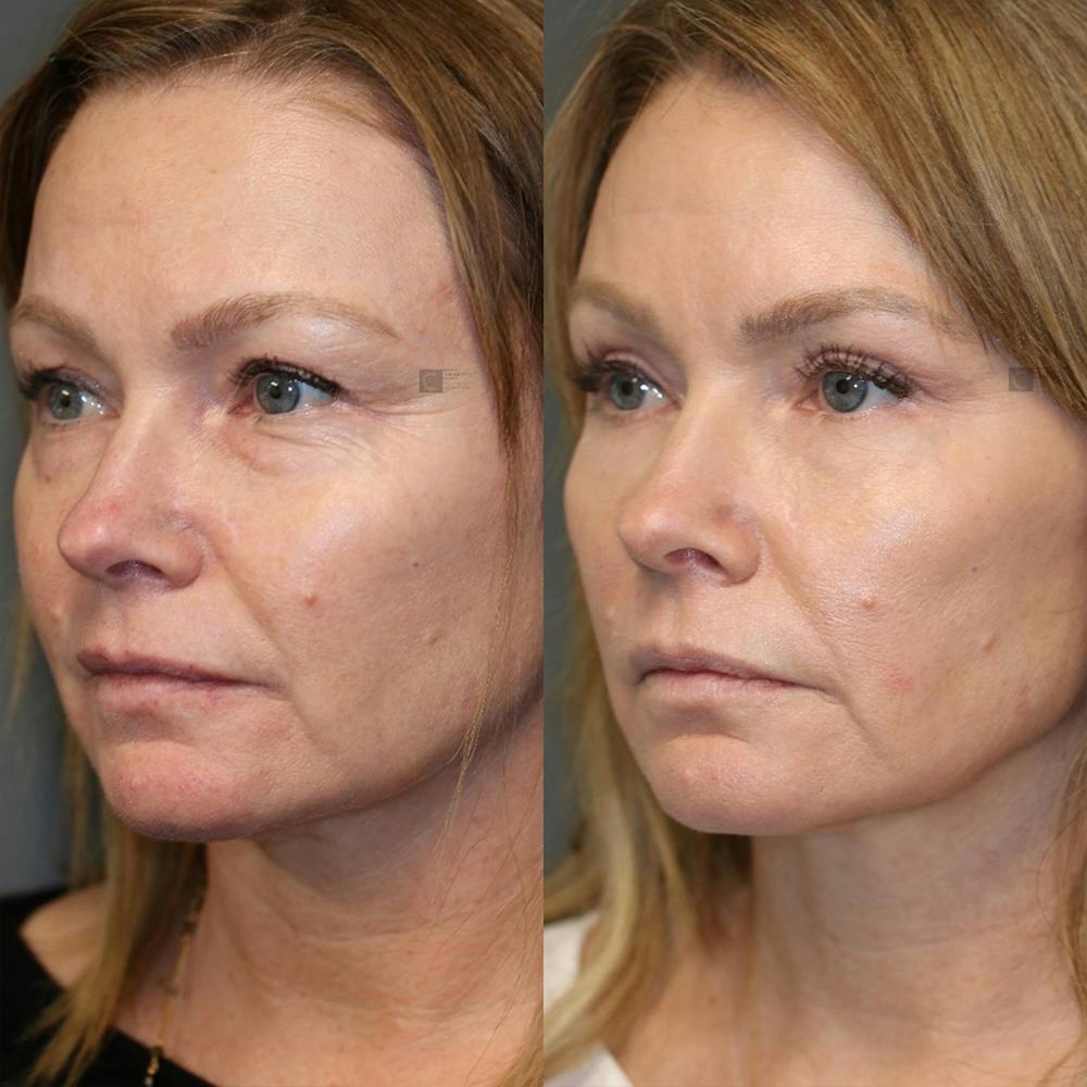  EnigmaLift - Upper Eyelid Surgery Before & After Gallery - Patient 25459160 - Image 5