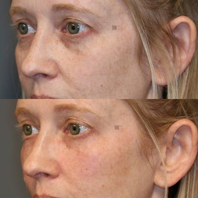ÔPTIMized Facial Fat Transfer Before & After Gallery - Patient 25459171 - Image 1