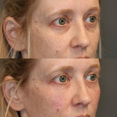 ÔPTIMized Facial Fat Transfer Before & After Gallery - Patient 25459171 - Image 2