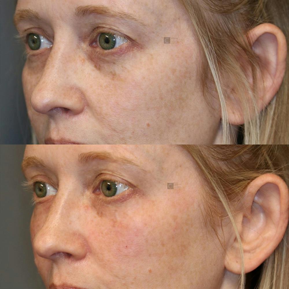 Dermal Fillers Before & After Gallery - Patient 25459180 - Image 1