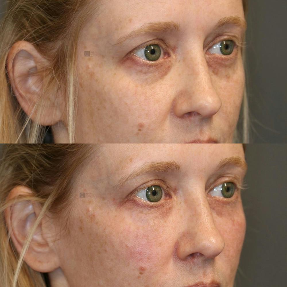 Dermal Fillers Before & After Gallery - Patient 25459180 - Image 2