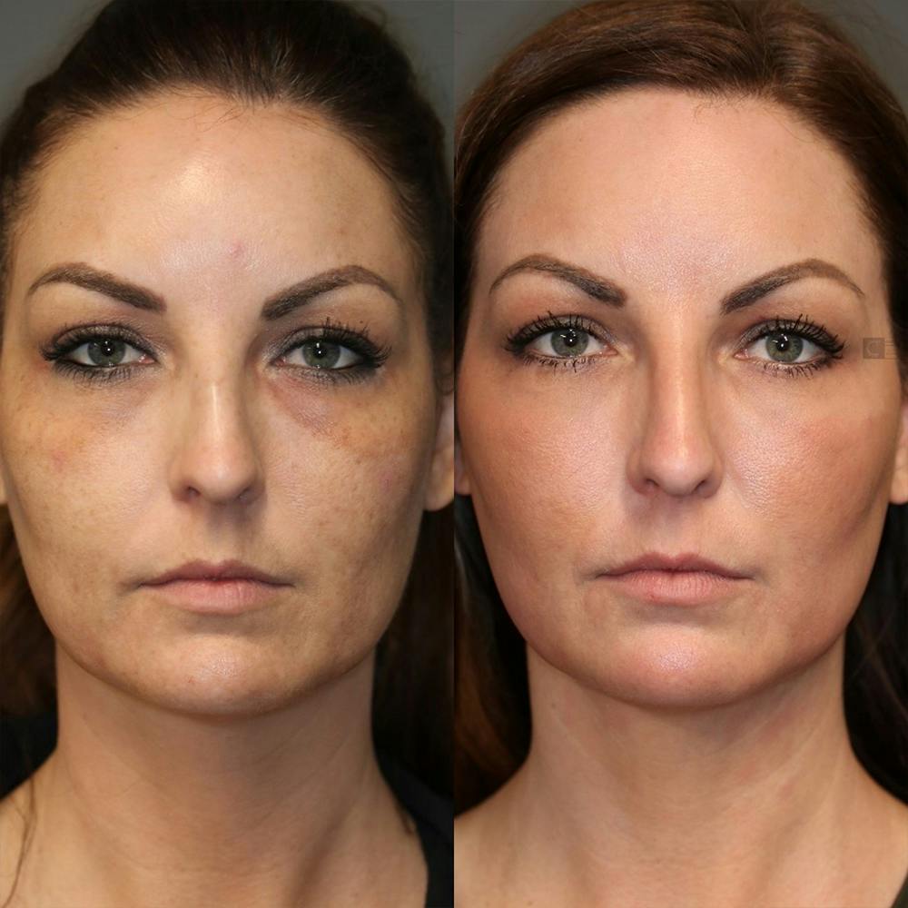 ÔPTIMized Laser Cocktail Before & After Gallery - Patient 25459241 - Image 1