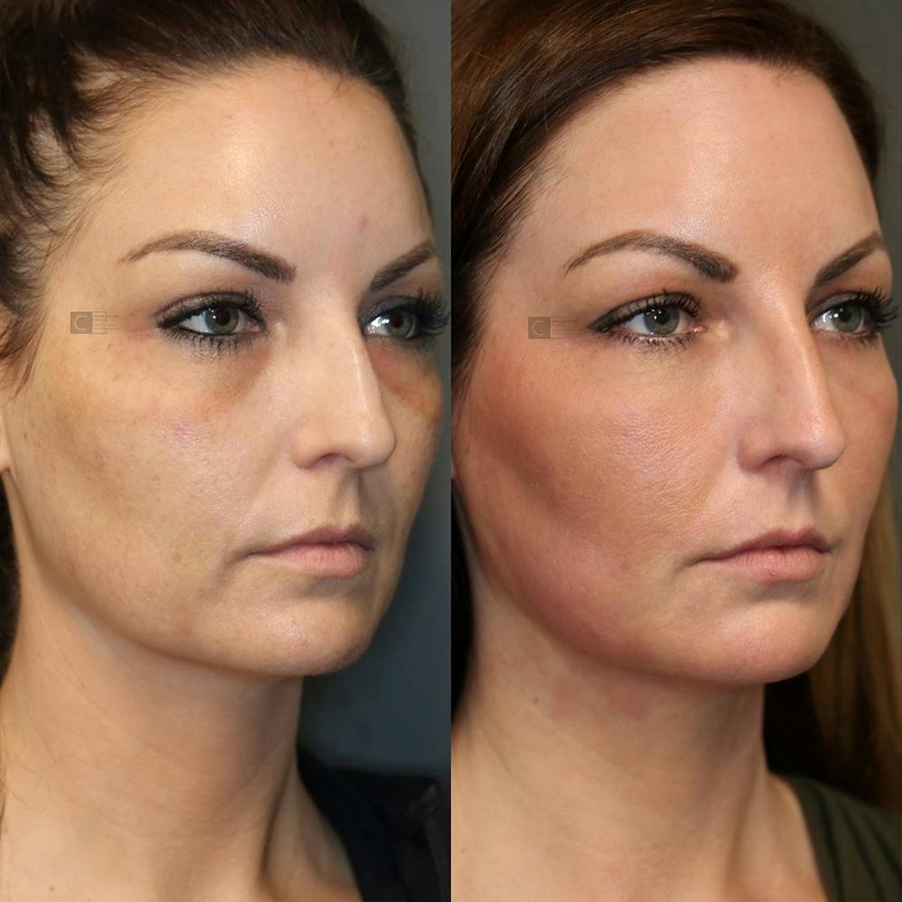 ÔPTIMized Laser Cocktail Before & After Gallery - Patient 25459241 - Image 2