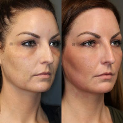 ÔPTIMized Laser Cocktail Before & After Gallery - Patient 25459241 - Image 2