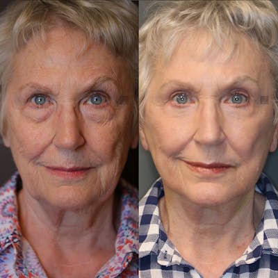 EnigmaLift - Facelift Before & After Gallery - Patient 25459461 - Image 1